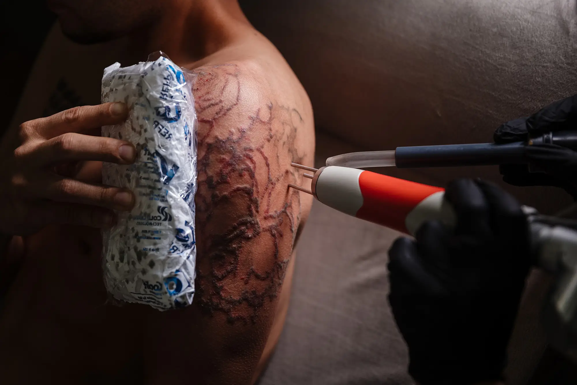 Laser specialist in protective eyewear guiding a tattoo removal handpiece across a client's upper arm