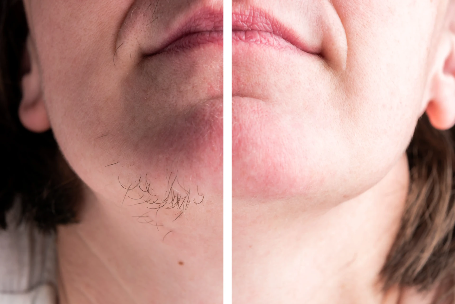 Side-by-side comparison of a woman's chin and jawline showing coarse hair before treatment and clear, smooth skin after laser hair removal